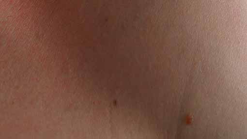 Trecate, "Sportello Vita": nuova campagna di prevenzione del melanoma